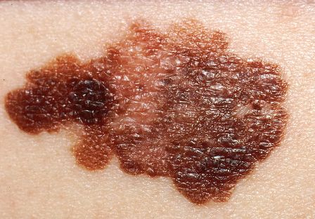 علائم و نشانه هایی که خبر از ابتلا به سرطان پوست می دهند